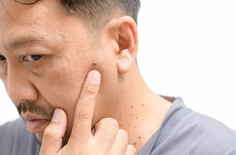 Skin Tags Removal Safe Methods and Prevention Tips